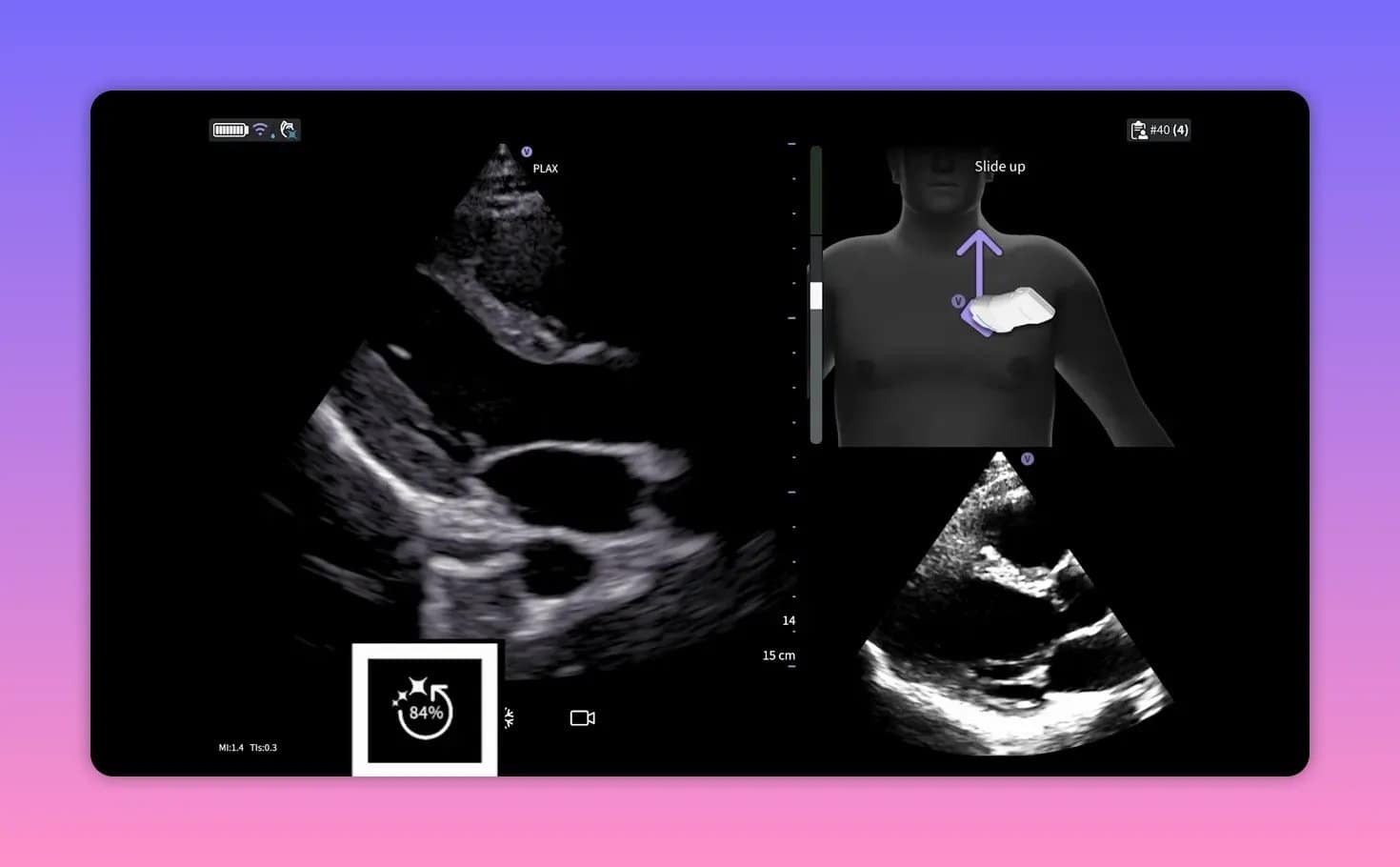 Vscan Air SL: Cardiac Guidance und AutoEF im Herzultraschall verstehen 6 Benutzeroberfläche mit markierter Schaltfläche Save Best Clip während einer Herzaufnahme