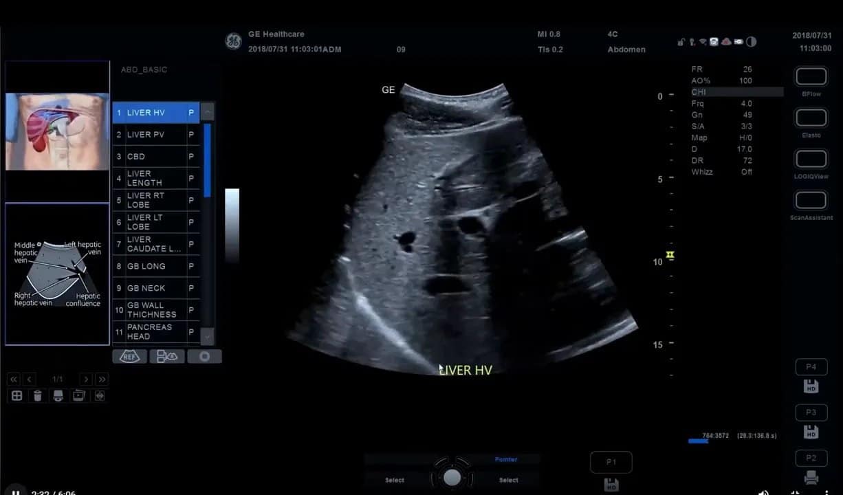 Scan Coach am Versana Premier: Einrichtung, Anwendung und eigene Protokolle Schritt für Schritt 6 Scan Coach Protokollschritte am Versana Premier während einer Abdomen-Untersuchung auswählen