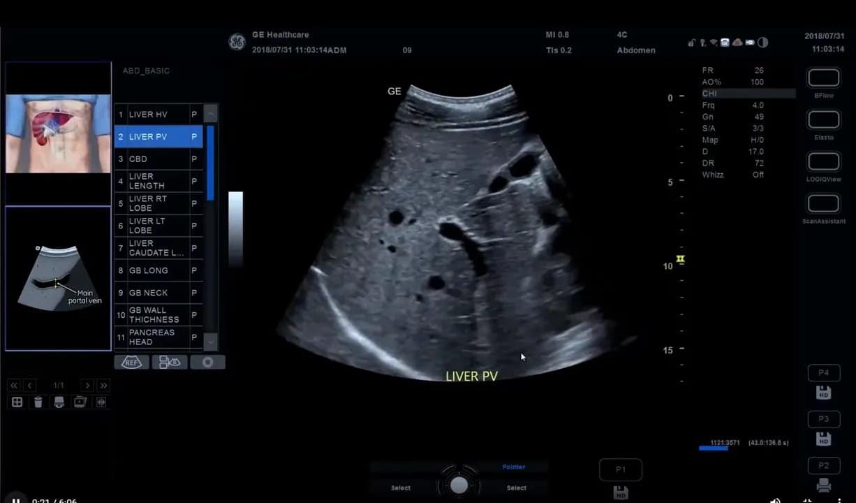 Scan Coach am Versana Premier: Einrichtung, Anwendung und eigene Protokolle Schritt für Schritt 2 Scan Coach Schrittliste neben Live-Ultraschallbild bei Abdomen-Anwendung