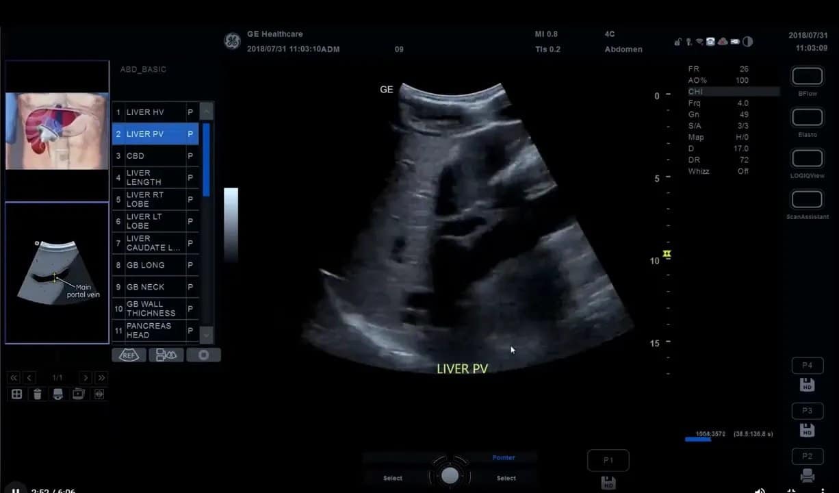 Scan Coach am Versana Premier: Einrichtung, Anwendung und eigene Protokolle Schritt für Schritt 7 Scan-Coach Referenzgrafik für Sondenposition im Protokoll auf dem Versana Premier (Leber, PV)