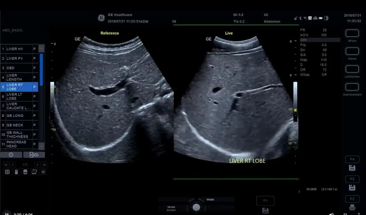 Scan Coach am Versana Premier: Einrichtung, Anwendung und eigene Protokolle Schritt für Schritt 9 Scan Coach Side-by-Side Vergleich Referenzbild vs. Livebild am Versana Premier