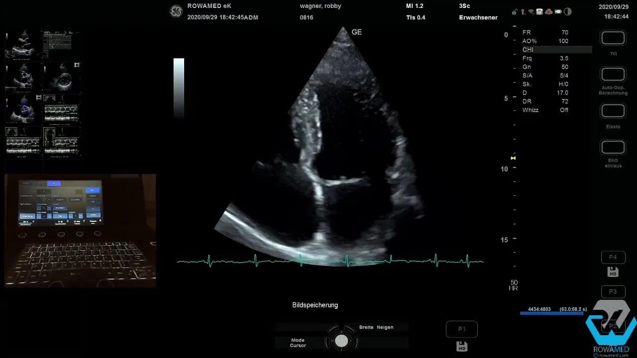 Transthorakale Echokardiographie Schritt für Schritt: So führen Sie eine vollständige Standarduntersuchung strukturiert durch 7 Transthorakale Echokardiographie: apikaler Vierkammerblick mit fokussierter Ansicht des linken Ventrikels