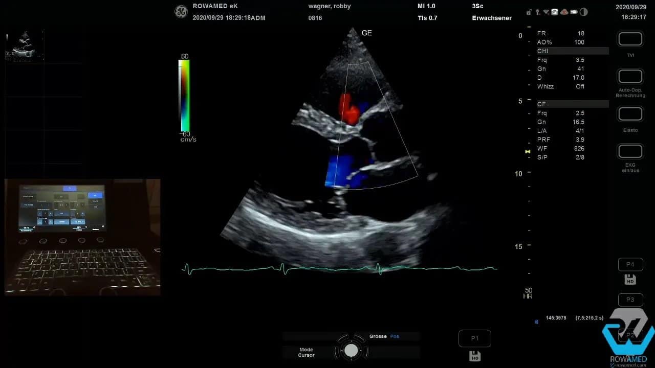 Transthorakale Echokardiographie Schritt für Schritt: So führen Sie eine vollständige Standarduntersuchung strukturiert durch 4 Farbdoppler-Screenshot der Transthorakalen Echokardiographie mit Regurgitationsjet