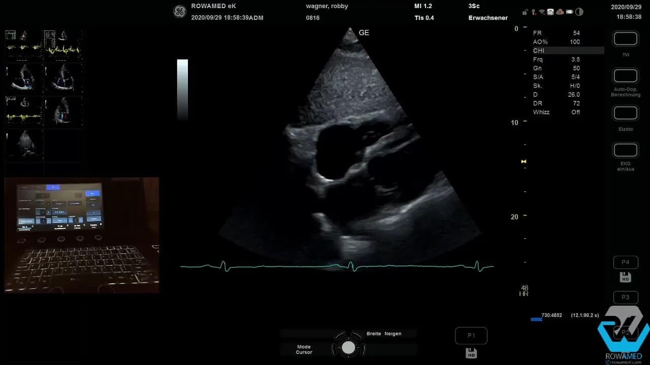 Transthorakale Echokardiographie Schritt für Schritt: So führen Sie eine vollständige Standarduntersuchung strukturiert durch 13 Subkostaler Vierkammerblick im Echokardiographiesystem mit klarer Darstellung von Vorhofstrukturen