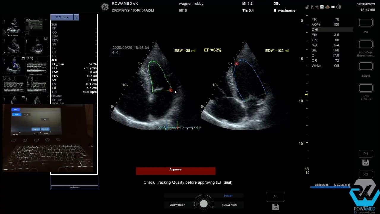 Transthorakale Echokardiographie Schritt für Schritt: So führen Sie eine vollständige Standarduntersuchung strukturiert durch 8 Transthorakale Echokardiographie: EF 62% mit Tracking-Qualitätsprüfung vor Freigabe
