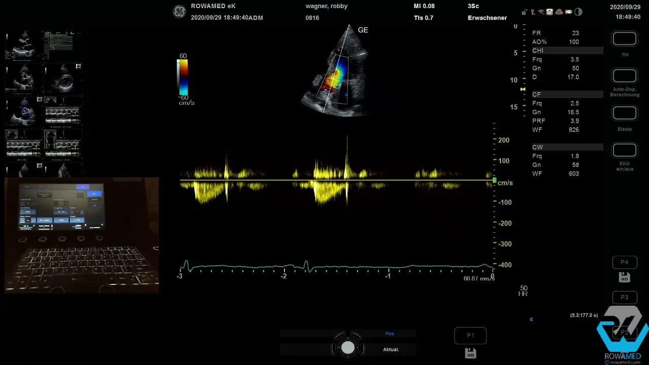 Transthorakale Echokardiographie Schritt für Schritt: So führen Sie eine vollständige Standarduntersuchung strukturiert durch 9 Transthorakale Echokardiographie: CW-Doppler-Kurve mit Messwerteinblendung zur Flussgeschwindigkeit über der Klappe