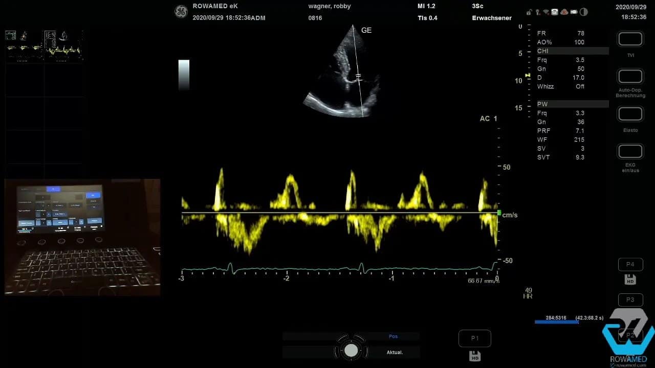 Transthorakale Echokardiographie Schritt für Schritt: So führen Sie eine vollständige Standarduntersuchung strukturiert durch 10 E- und A-Wellenprofil im Spektral-Doppler zur Beurteilung der diastolischen Funktion (E/A-Verhältnis)
