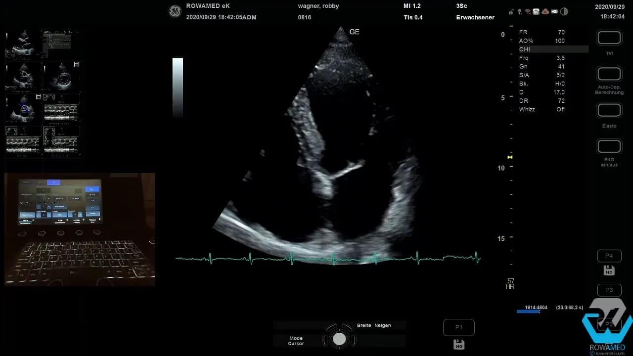 Transthorakale Echokardiographie Schritt für Schritt: So führen Sie eine vollständige Standarduntersuchung strukturiert durch 2 Transthorakale Echokardiographie – gut erkennbare Standardebene mit Messkurve