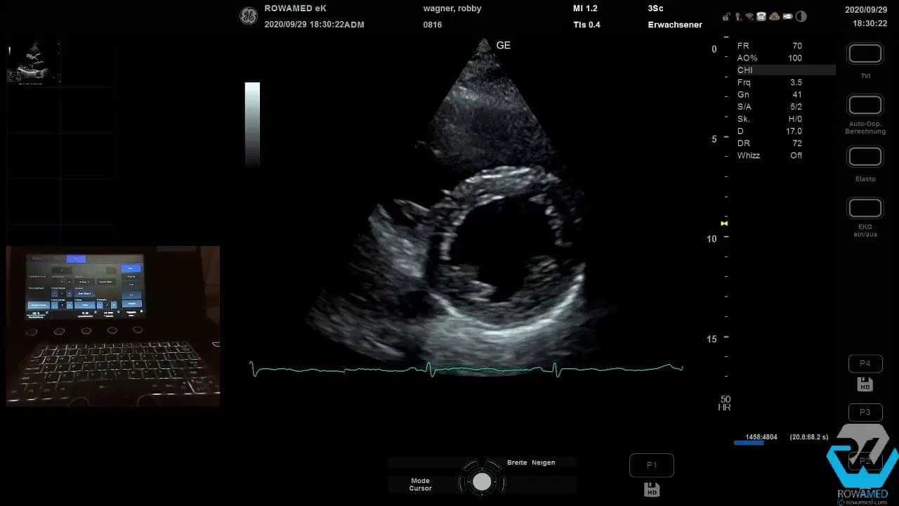 Transthorakale Echokardiographie Schritt für Schritt: So führen Sie eine vollständige Standarduntersuchung strukturiert durch 5 Echokardiographie-Monitorbild mit erkennbarer Aortenklappenebene zur planimetrischen Messung