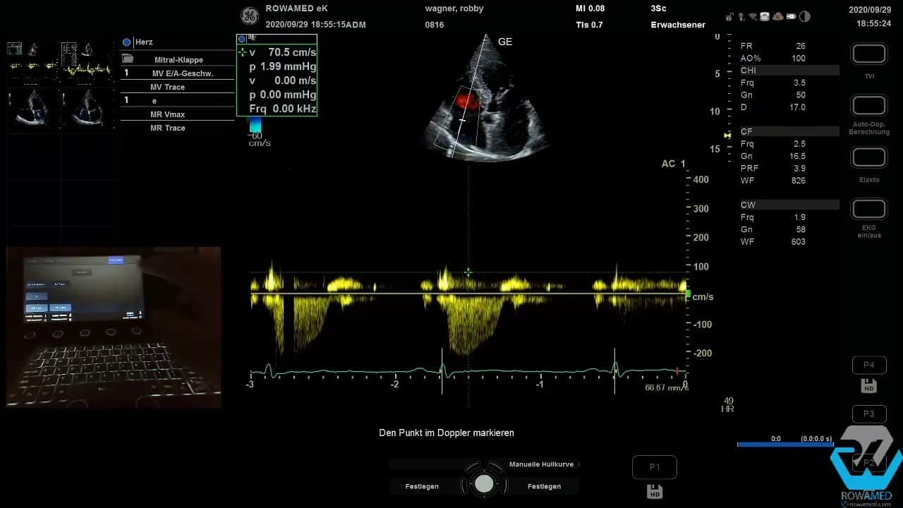 Transthorakale Echokardiographie Schritt für Schritt: So führen Sie eine vollständige Standarduntersuchung strukturiert durch 12 Transthorakale Echokardiographie: Messparameter zur TR-Vmax und TR-maxPG im Dopplerprofil der Trikuspidalinsuffizienz