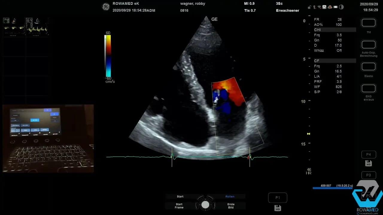 Transthorakale Echokardiographie Schritt für Schritt: So führen Sie eine vollständige Standarduntersuchung strukturiert durch 11 Trikuspidalinsuffizienz im Farbdoppler: dokumentierter Regurgitationsbereich für TR Vmax