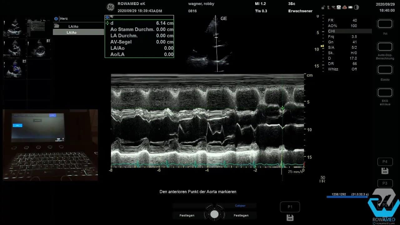 Transthorakale Echokardiographie Schritt für Schritt: So führen Sie eine vollständige Standarduntersuchung strukturiert durch 6 Transthorakale Echokardiographie: M-Mode mit markierter Aortenwurzel und ausgelesenen Durchmesserwerten