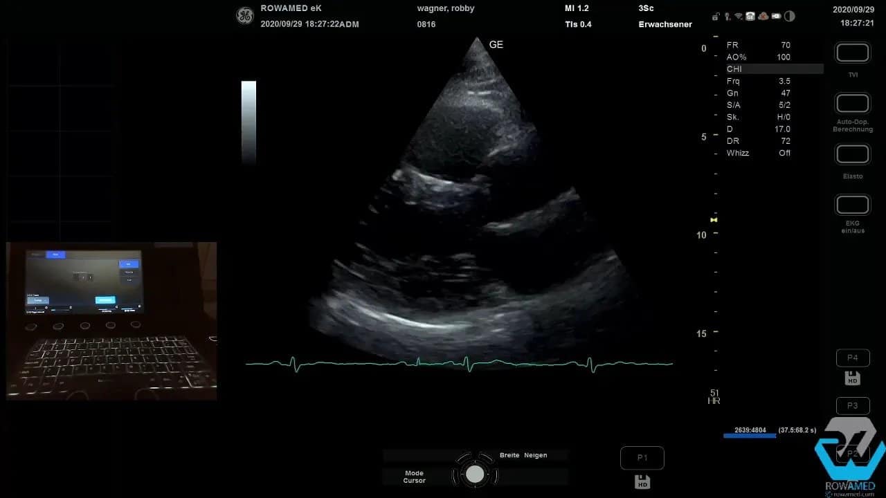 Transthorakale Echokardiographie Schritt für Schritt: So führen Sie eine vollständige Standarduntersuchung strukturiert durch 3 Transthorakale Echokardiographie parasternal lange Achse: linksventrikuläre Ebene und Messübersicht
