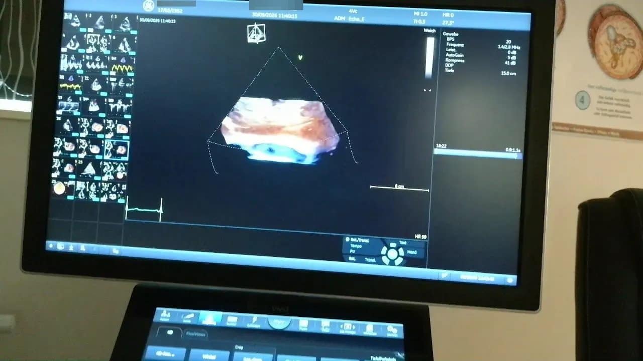 Vivid 4D: Ein Praxisbeispiel 5 Ultraschallmonitor mit einer einzelnen seitlich angeschnittenen räumlichen Darstellung