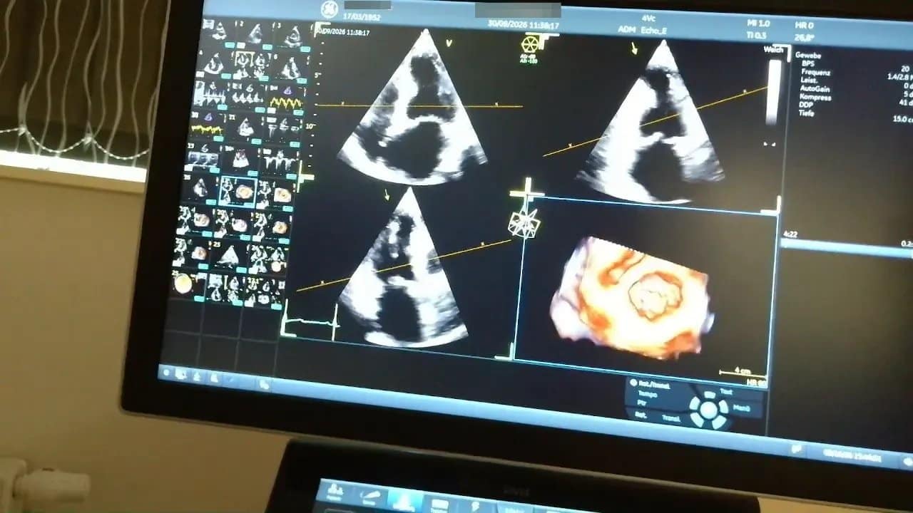 Vivid 4D: Ein Praxisbeispiel 2 Ultraschallmonitor mit mehreren Schnittbildern und räumlicher Klappendarstellung