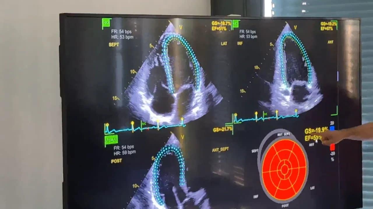 Vivid 4D: Schritt für Schritt von der Bildaufnahme zur kontrollierten Herzanalyse 4 Monitor mit drei Herzultraschallansichten, grünen Konturen und kreisförmiger farbiger Segmentkarte