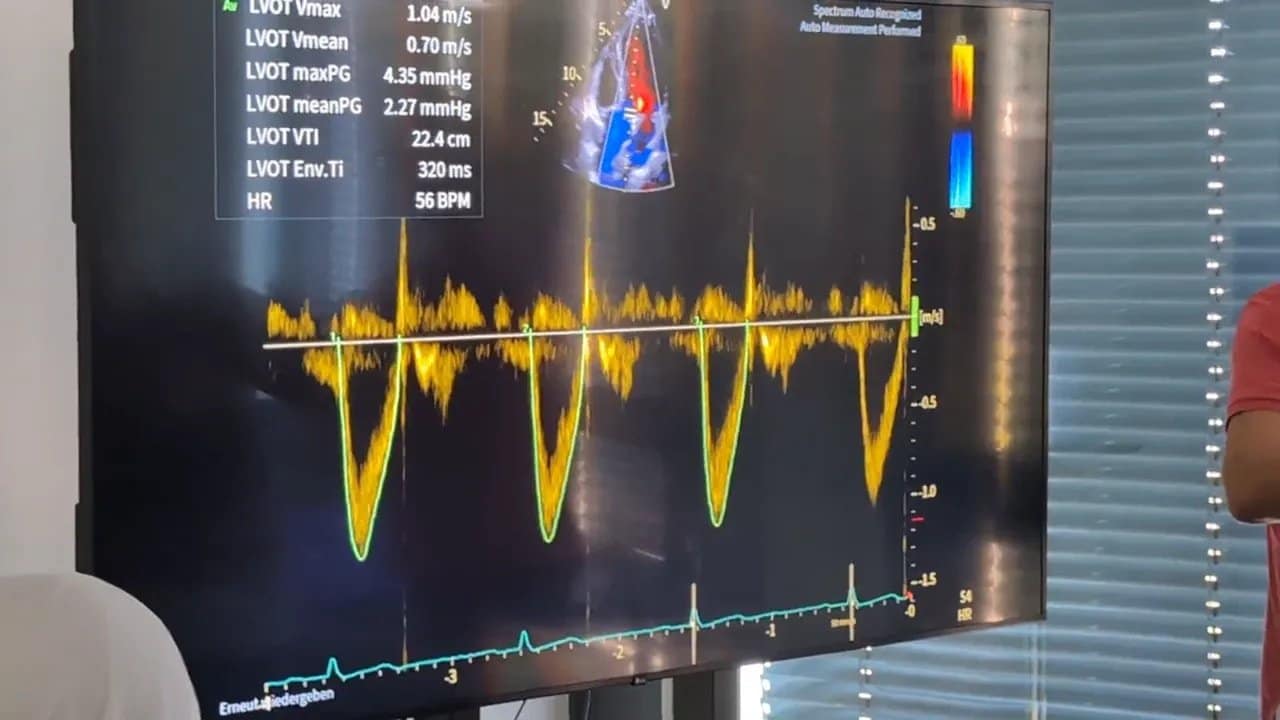 Vivid 4D: Schritt für Schritt von der Bildaufnahme zur kontrollierten Herzanalyse 3 Ultraschallmonitor mit gelbem Dopplerspektrum, Messangaben und grüner EKG-Kurve