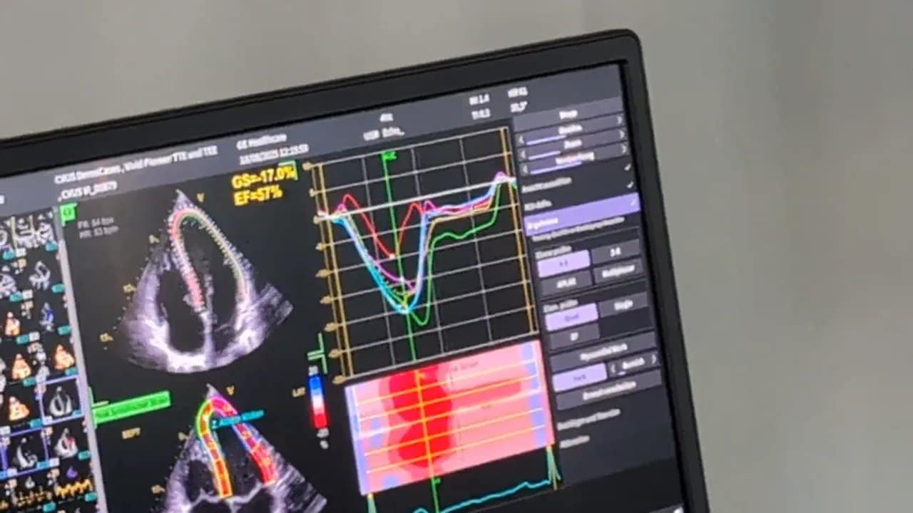 Vivid 4D: Schritt für Schritt von der Bildaufnahme zur kontrollierten Herzanalyse 5 Ultraschallmonitor mit Herzansicht, mehreren farbigen Kurven und einer farbigen Ergebnistabelle