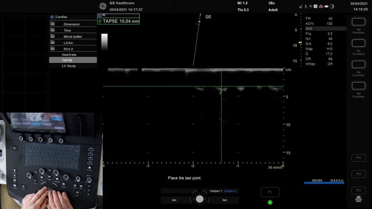 TAPSE Messung am Versana 11 Vesana M‑Mode Anzeige mit Kalipern und abgelesenem TAPSE Wert 10,04 mm