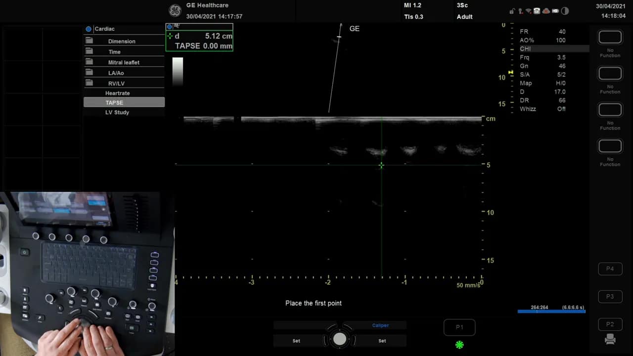 TAPSE Messung am Versana 9 Vesana M‑Mode mit Kalibern, Anweisung 'Place the first point' und TAPSE 0.00 mm