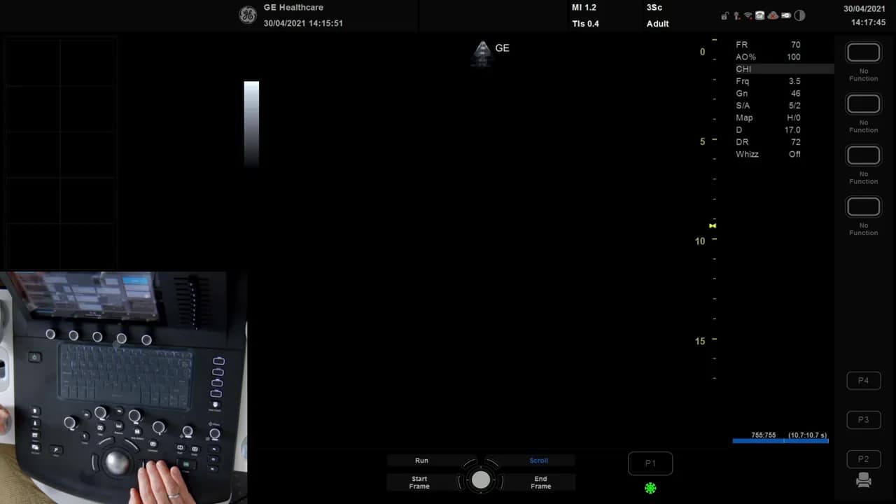 TAPSE Messung am Versana 8 Hauptbildschirm des Ultraschallgeräts mit großem Bildfeld, Bedienfeld und Händen zum Verschieben der Anzeige