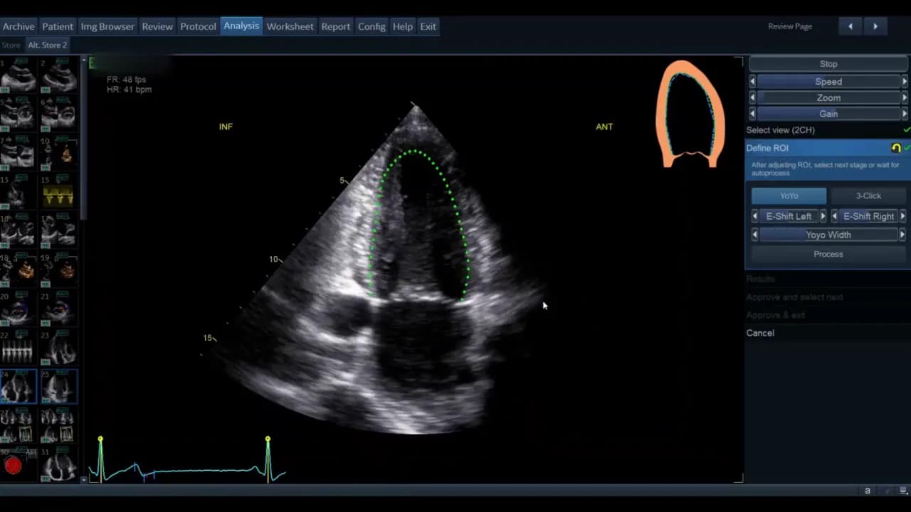AutoEF — Schritt-für-Schritt Anleitung 9 Klares Ultraschallbild Apikal 4‑Kammer mit grüner ROI‑Markierung und AutoEF Bedienfeld