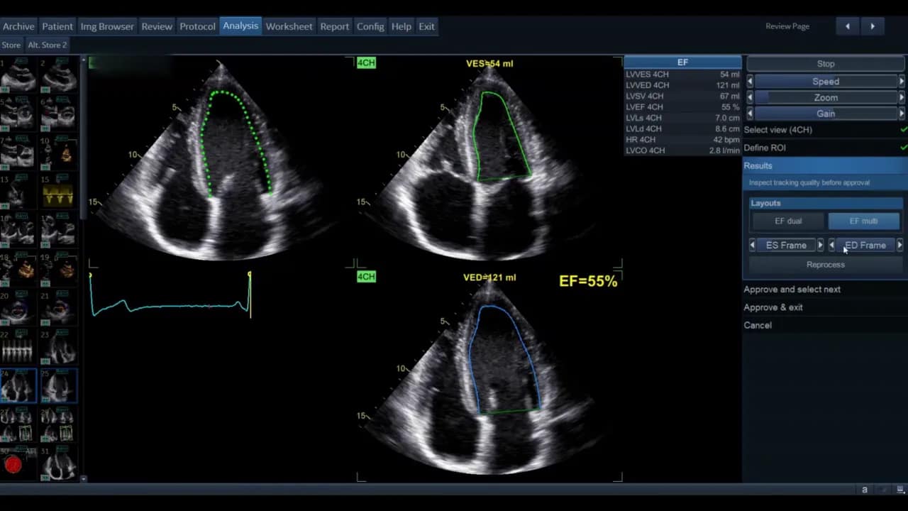 AutoEF — Schritt-für-Schritt Anleitung 7 AutoEF Benutzeroberfläche mit deutlich sichtbaren ES Frame / ED Frame Buttons, Reprocess Bereich und konturierten LV‑Bildern