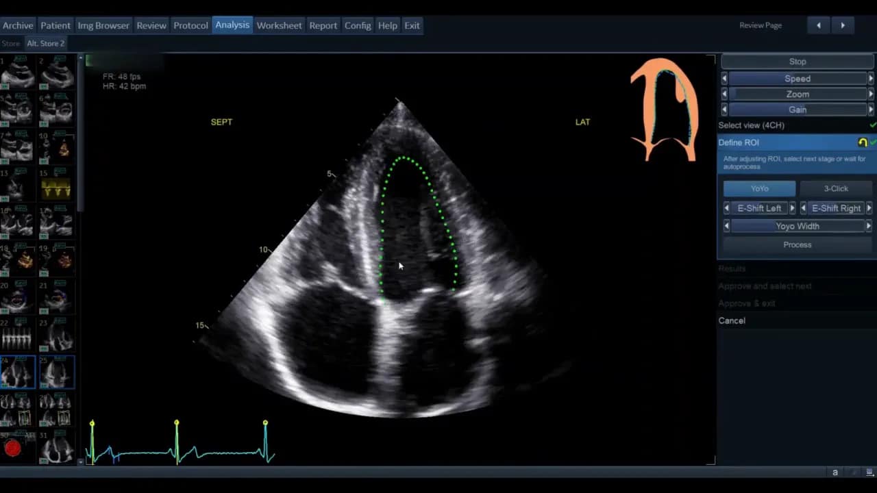 AutoEF — Schritt-für-Schritt Anleitung 2 Apikale Vierkammeransicht (APL4) mit grüner ROI‑Kontur, Beschriftungen SEPT und LAT sowie Herz‑Piktogramm