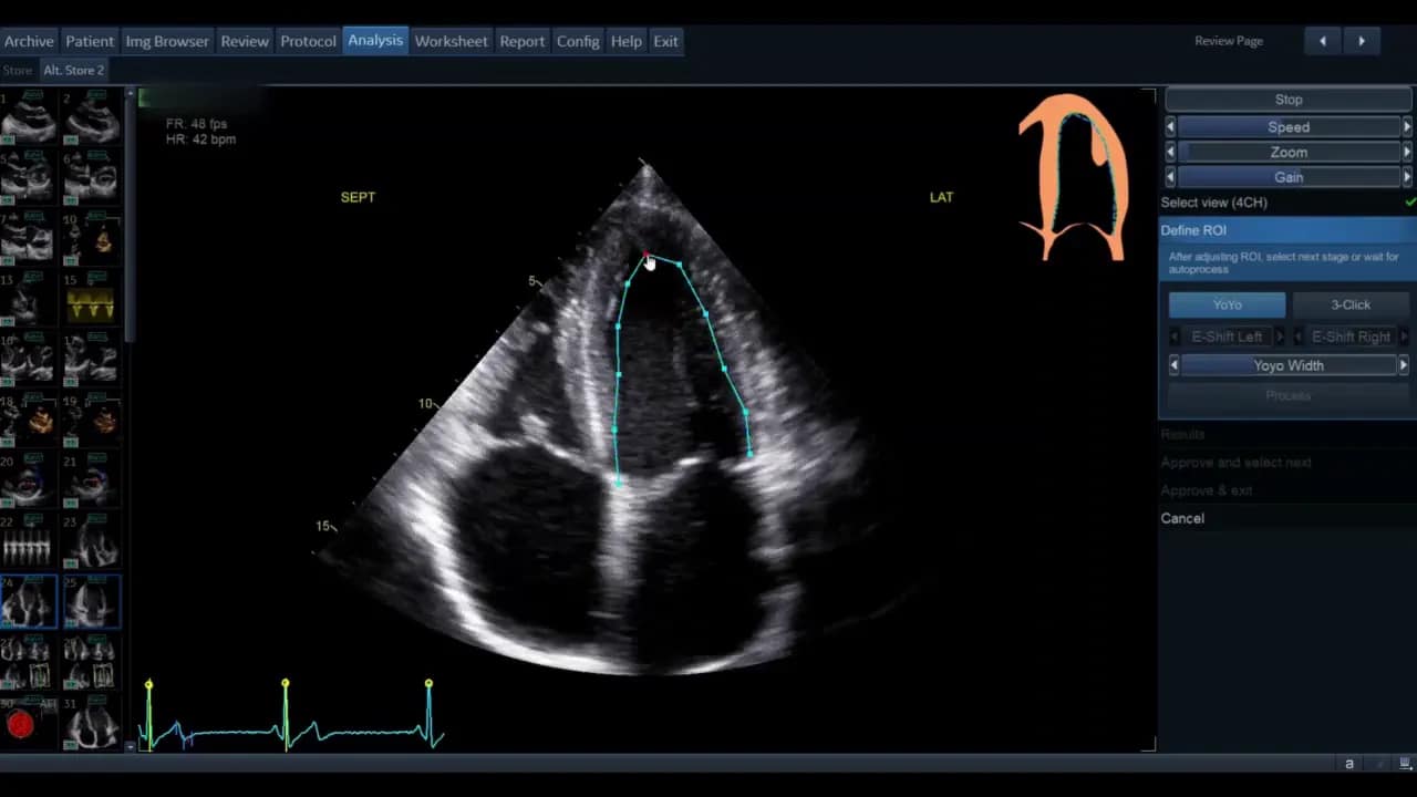 AutoEF — Schritt-für-Schritt Anleitung 11 Apikale Vierkammeransicht mit editierbarer Kontur und Griffpunkten zur Feinjustierung