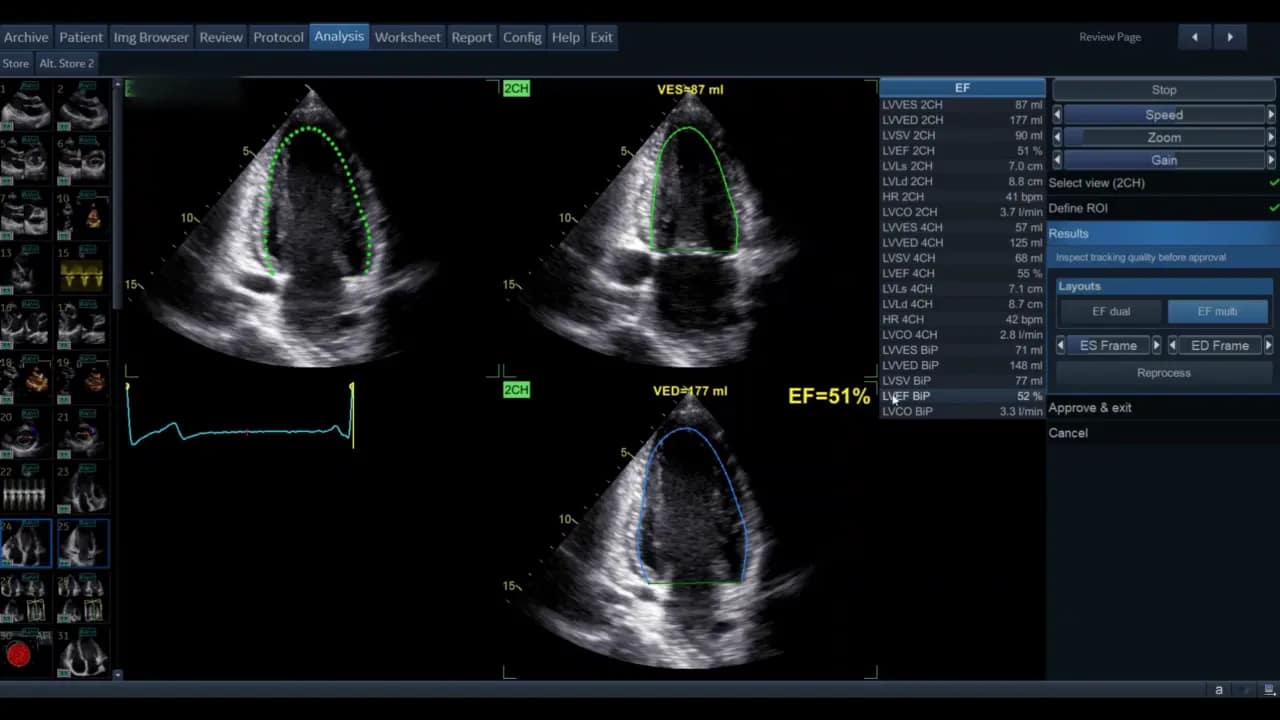 AutoEF — Schritt-für-Schritt Anleitung 10 Bildschirmaufnahme der AutoEF‑Software mit drei apikalen Ansichten, Endokardkonturen und dem hervorgehobenen EF‑Wert 51 Prozent.