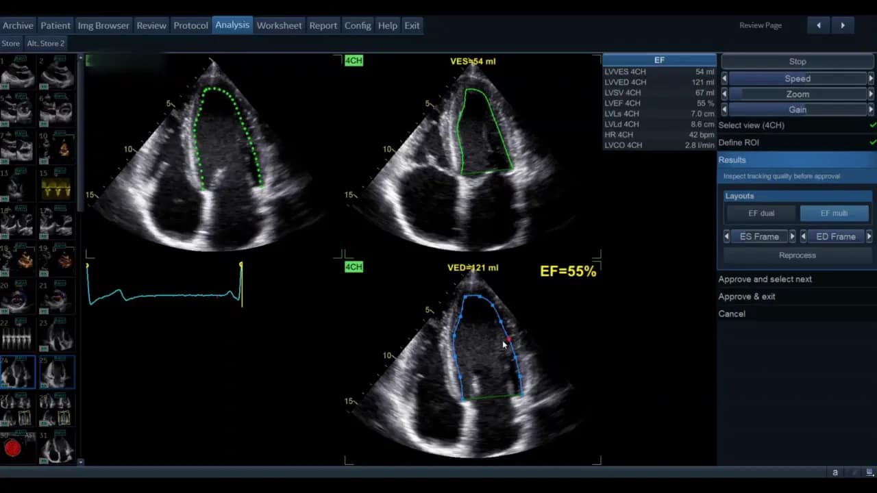 AutoEF — Schritt-für-Schritt Anleitung 5 AutoEF Dual‑Display mit ED/ES Konturen und EF 55 Prozent