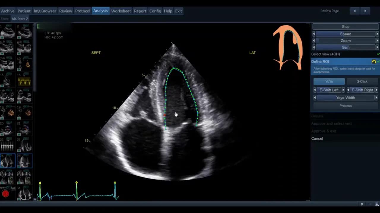 AutoEF — Schritt-für-Schritt Anleitung 3 Apikale 4‑Kammer Ultraschallaufnahme mit grüner ROI‑Kontur und rotem Griffpunkt auf Analyse‑Software