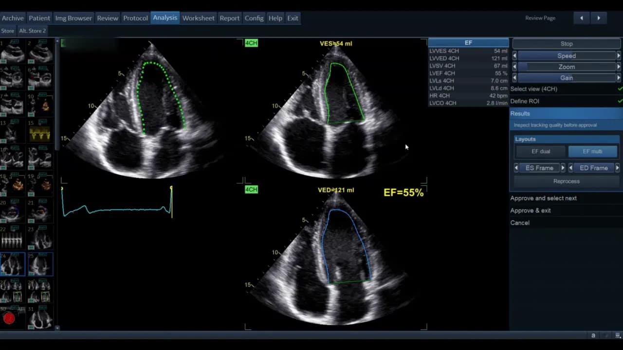 AutoEF — Schritt-für-Schritt Anleitung 6 AutoEF Bildschirm mit drei Panels, EKG‑Kurve, endokardialen Konturen und angezeigter EF von 55%