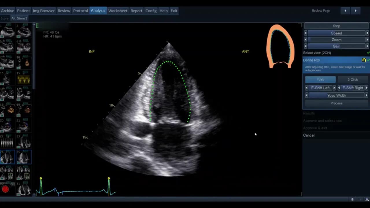 AutoEF — Schritt-für-Schritt Anleitung 8 AutoEF Interface zeigt 'Select view (2CH)' und grüne ROI‑Punkte am LV