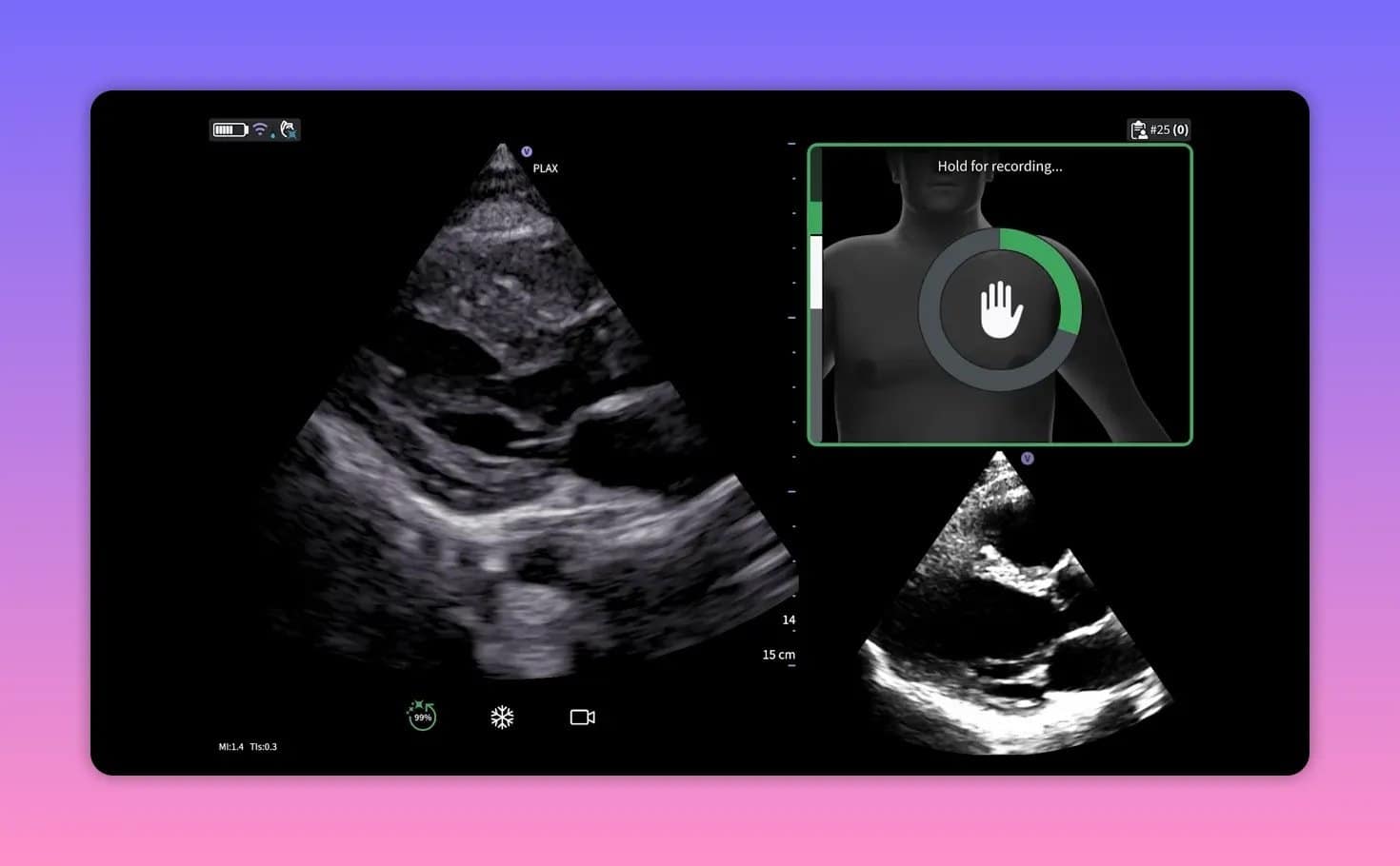 Vscan Air SL: Cardiac Guidance und AutoEF im Herzultraschall verstehen 1 Ultraschallbild mit grünem Qualitätskreis in der Führungseinblendung