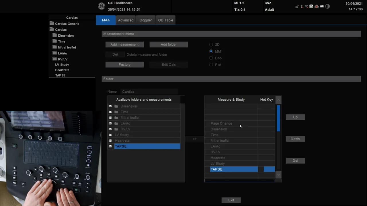 Vesana Messmenü mit TAPSE in der rechten (aktiven) Messliste, Zuweisung sichtbar